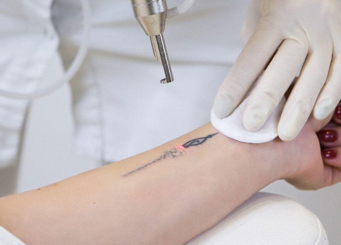 Laser & Tattoo Removal — I am ME Beauty Lounge, Bang Tao, Phuket